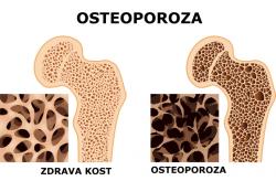 Osteroporoza